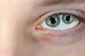 世界上双瞳孔的人看东西会有什么不一样？图片