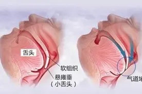 打鼾竟暗藏4大危害！如何减轻打鼾？图片