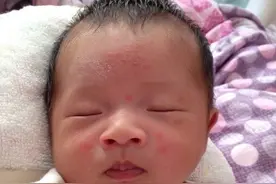 月嫂：湿疹瘙痒折磨宝宝睡不好？3个实用妙招，宝宝少受罪图片