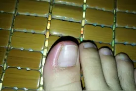 为什么越来越多的人会得甲沟炎？图片