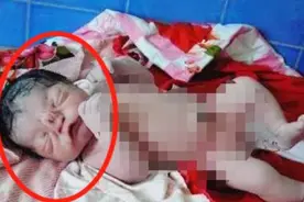 高龄产妇生下“猪八戒”，丈夫本打算抛弃，医生的一席话救下孩子图片