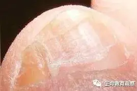 为什么一些中国人的小脚趾甲是两瓣的？图片