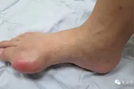 痛风不就是关节痛吗？为啥还会长个包呀？原来得了痛风不仅是会痛，还会长“石头”图片