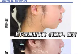 嘴凸+咬合不好+深覆合深覆盖，实现正畸变美｜重庆牙齿矫正图片