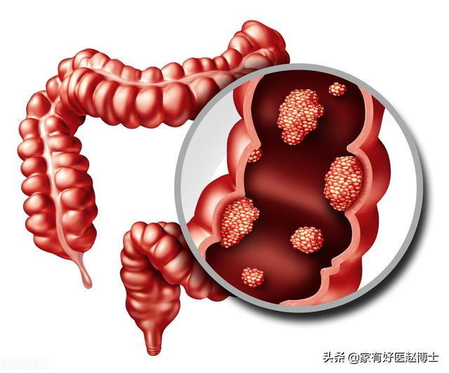 四种“高致癌性”炎症并不少见，降低患癌风险从预防和早诊做起