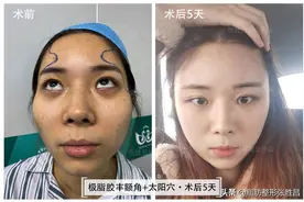 颧骨高只能颧骨内推？她怕开刀磨骨创伤大，仅做脂肪填充就改善了图片