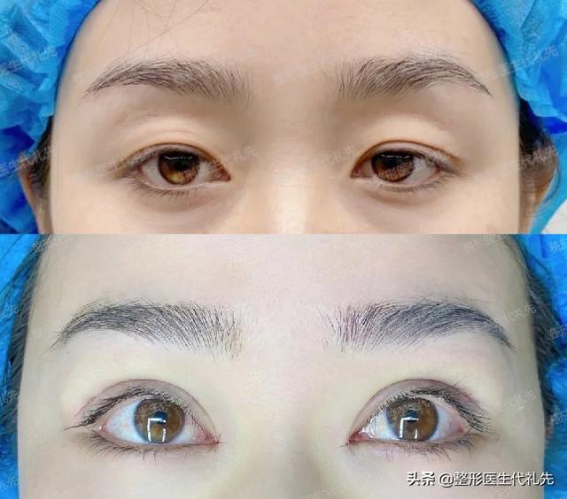 聊一聊双眼皮的款式形态都有哪些,准备做双眼皮的姐妹们来看看