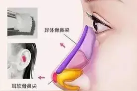 鼻综合手术术前准备工作图片