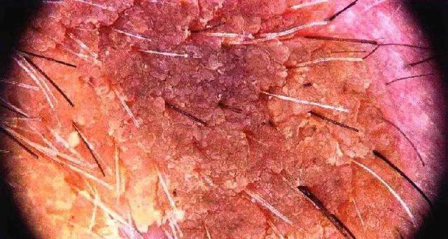 治疗角化性皮炎