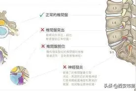 #健康科普汇# 【关于腰椎间盘突出，你需要知道的小知识—哪些腰椎间盘最容易突出？突出会有哪些症状？】图片