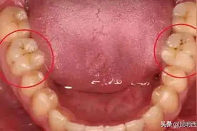 可怕！牙齿上的小黑点不痛不痒，竟然隐藏着大隐患...图片