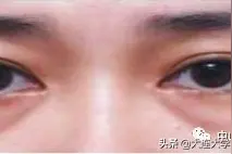 【爱美•科普】有一种“闹心”叫你有眼袋!图片