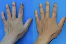 硬皮病病例分享——变硬的不仅是皮肤，还有笑容和内脏图片