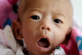 小孩怎么吃都不长个，小心有疳积！这几点做到了可有效防治疳积图片