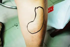 脂肪瘤很常见！脂肪肉瘤您听说过吗？只差“肉”字，却有良恶之分图片