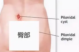 小伙臀部长“痘痘”，开刀发现藏着一缕毛！医生：这种病别拖着图片