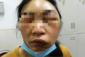 虫子叮了一口，阿姨全脸暴肿差点窒息！医生提醒这些楼层的居民都要注意图片