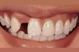 牙齿缺失之后都有哪些修复方式？除了种植还能选哪种？长知识了图片