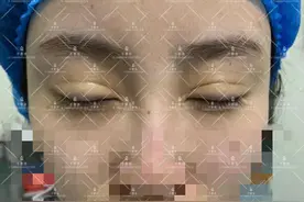 一名双眼皮凹陷性瘢痕患者的修复经历图片