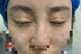 一名双眼皮凹陷性瘢痕患者的修复经历图片
