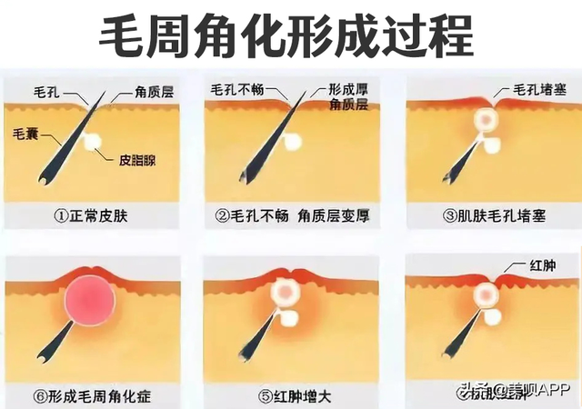 脱毛膏会毛周角化吗