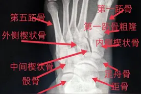 学习《X线读片指南》骨、关节系统——足图片