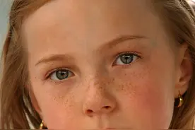 长在唇上的黑斑，可能预示着腹腔的肿瘤图片