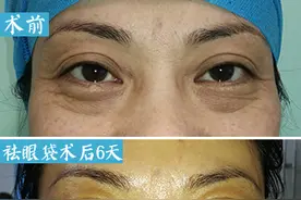外路祛眼袋手术后第6天拆线，疤痕长这样图片