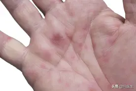 身上长了很多小红点？注意：身上长很多小红点，或是肝病信号图片