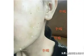5个快问快答，给那些想做“面部线雕”的人一些真实建议图片