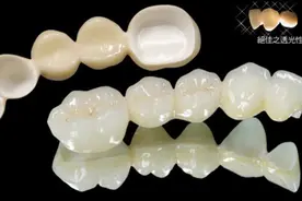烤瓷牙，全瓷牙？傻傻分不清图片