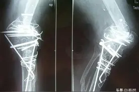 一具“铁丝接骨”的真人骨骼标本，揭示其主人经历怎样的惨痛？图片