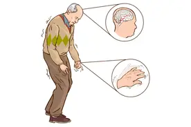 帕金森病为什么会遇上异动症？该如何应对？图片