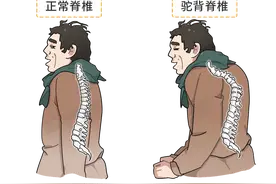 如何消除驼背和脖子前倾？3个动作，坚持一个月，体态明显改善图片