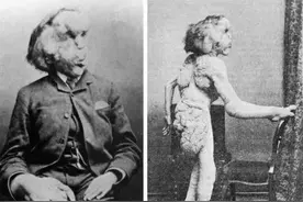 曾经感染3000万国人的丝虫病，到底有多可怕？这段历史讲给你听图片