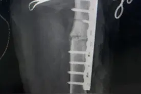 3D打印技术让病人“脱胎换骨”图片