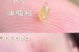 脸上粉刺放任成了“小米粒”咋办？这样做，脸成光滑鸡蛋清图片