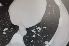 肺实性结节10mm严重吗？35岁肺结节发现居然已是肺癌中晚期图片