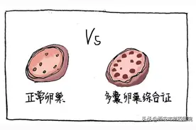 #健康中国行动2030# 什么是多囊卵巢综合征？图片