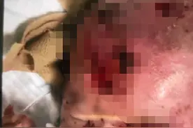 三月龄女婴在家遭飞来横祸！原因成谜图片