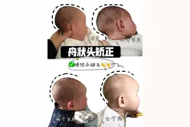 怎么给宝宝睡出好头型！舟状头矫正图片
