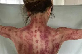 48岁郑秀文分享背部刮痧照片惹关注，网民看呆：好舒服呀图片