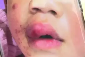 小孩在游乐场摔伤嘴巴 赔偿费用双方协商不下图片