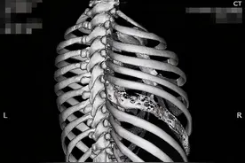 胸腔镜下切除全长肋骨肿瘤，只有两个2.5厘米的小切口！图片