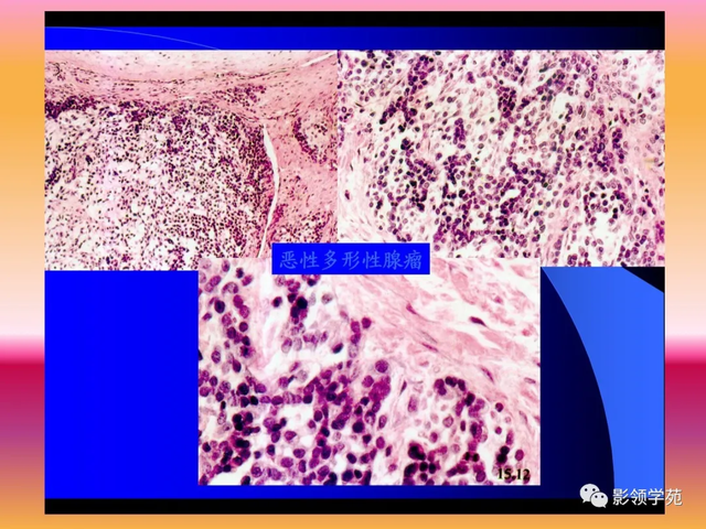 腮腺角化型鳞癌