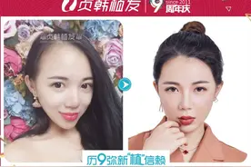 免费植发！招募脱发、秃顶、发际线高、脑门大的市民图片