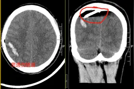 危急！4cm钢钉射入佛山小伙大脑，广州医生开颅“拔钉”图片