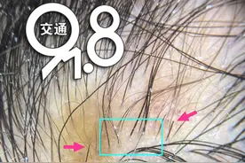 杭州十岁女孩出现斑秃？医生：是她自己拔的图片