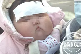 南昌5月龄宝宝体重飙升至20斤，宝妈怀疑面霜有问题：脸越来越大图片