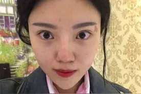 鼻子假体下滑修复，重做了喜欢的小翘鼻图片